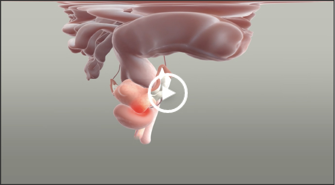 Illustration of subserosal uterine fibroids